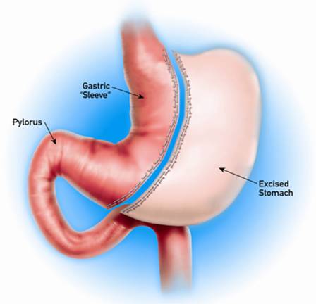 sleeve gastrectomy